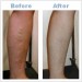 varicose_vein_before_after